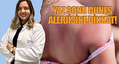 Yaz Sonu Güneş Alerjisine Dikkat!